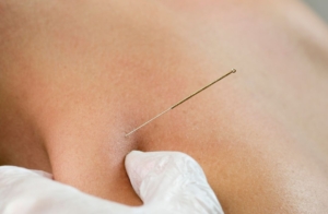 dry needling maryland