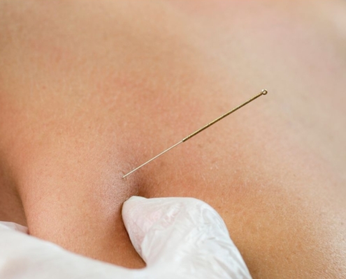 dry needling maryland