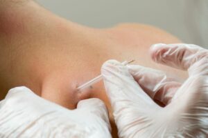 Six Things to Know About Therapeutic Dry Needling
