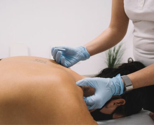dry needling for muscle pain treatment
